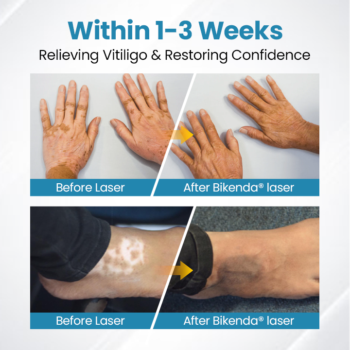 Nurbini®DermaBeam Vitiligo Therapy Device