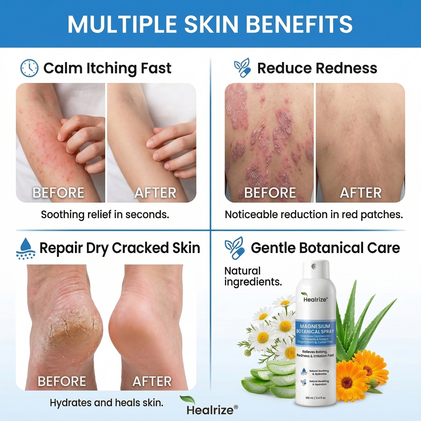 🔥Healrize® Magnesium Botanical Spray – ✅FDA Certified| Advanced Skin Recovery for Psoriasis & Eczema | Rapid Soothing, Steroid-Free