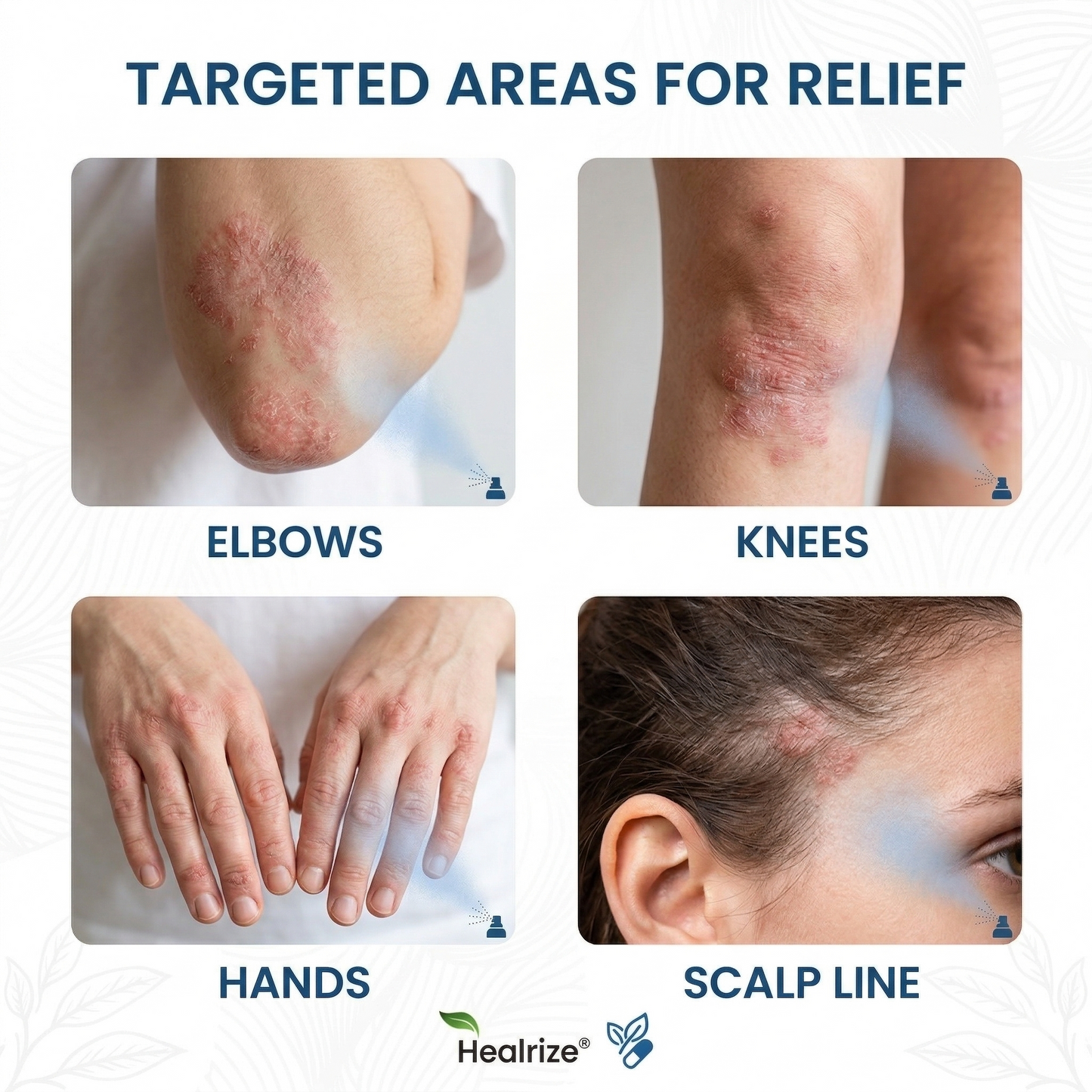 🔥Healrize® Magnesium Botanical Spray – ✅FDA Certified| Advanced Skin Recovery for Psoriasis & Eczema | Rapid Soothing, Steroid-Free