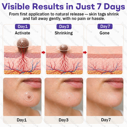 Dobshow® Wart and mole removal microneedle patch